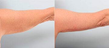 Brachioplasty (Arm Lift) before and after photos in Houston, TX, Patient 27127