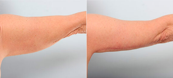Brachioplasty (Arm Lift) before and after photos in Houston, TX, Patient 27127