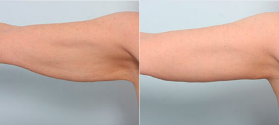 Brachioplasty (Arm Lift) before and after photos in Houston, TX, Patient 27127