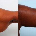 Brachioplasty (Arm Lift) before and after photos in Houston, TX, Patient 27132