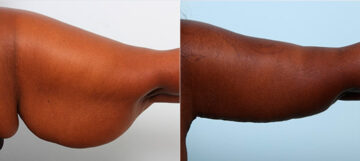 Brachioplasty (Arm Lift) before and after photos in Houston, TX, Patient 27132