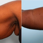 Brachioplasty (Arm Lift) before and after photos in Houston, TX, Patient 27132