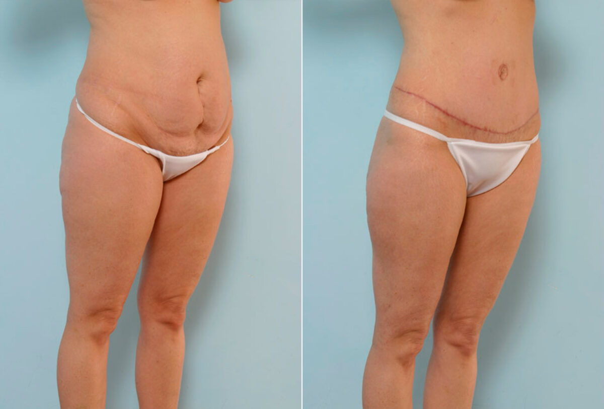 Abdominoplasty before and after photos in Houston, TX, Patient 24487