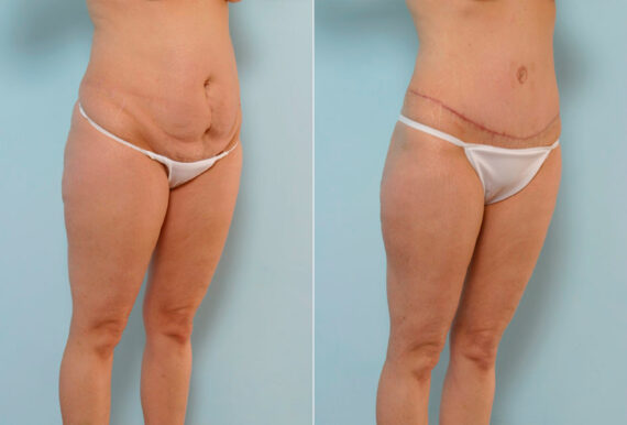 Tummy Tuck/Abdominoplasty before and after photos in Houston, TX, Patient 24487
