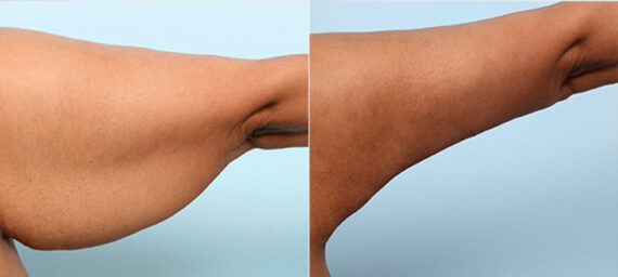 Brachioplasty (Arm Lift) before and after photos in Houston, TX, Patient 27137