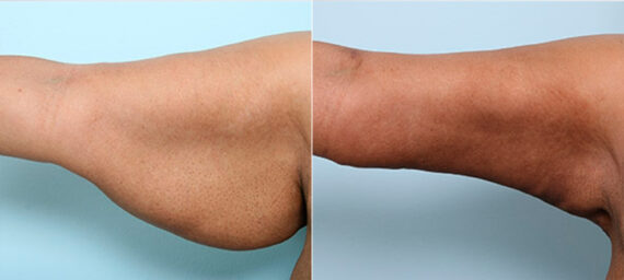 Brachioplasty (Arm Lift) before and after photos in Houston, TX, Patient 27137