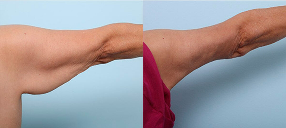 Brachioplasty (Arm Lift) before and after photos in Houston, TX, Patient 27142