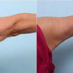 Brachioplasty (Arm Lift) before and after photos in Houston, TX, Patient 27142