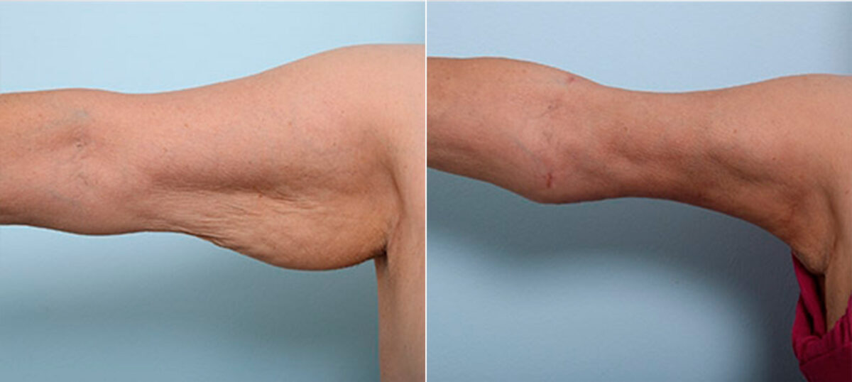 Brachioplasty (Arm Lift) before and after photos in Houston, TX, Patient 27142