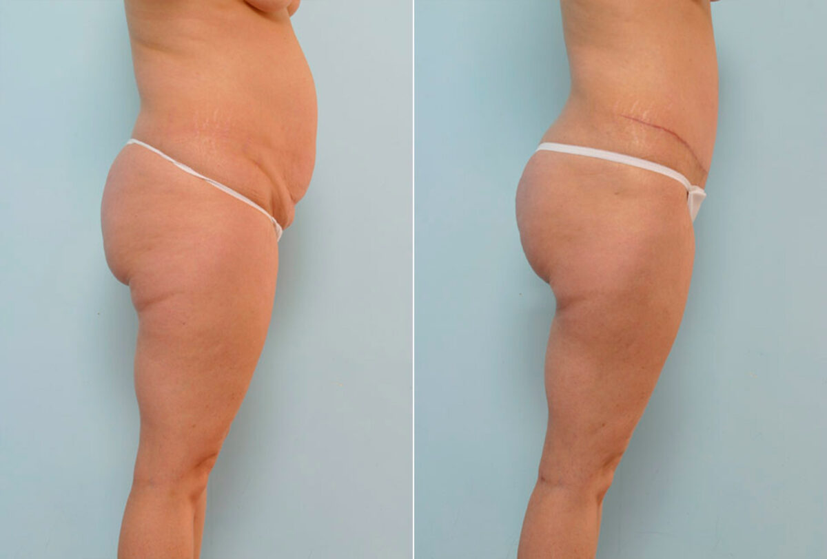 Abdominoplasty before and after photos in Houston, TX, Patient 24487