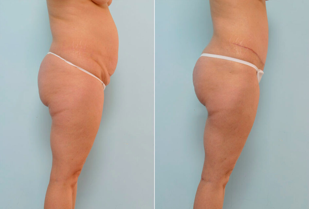 Tummy Tuck/Abdominoplasty before and after photos in Houston, TX, Patient 24487
