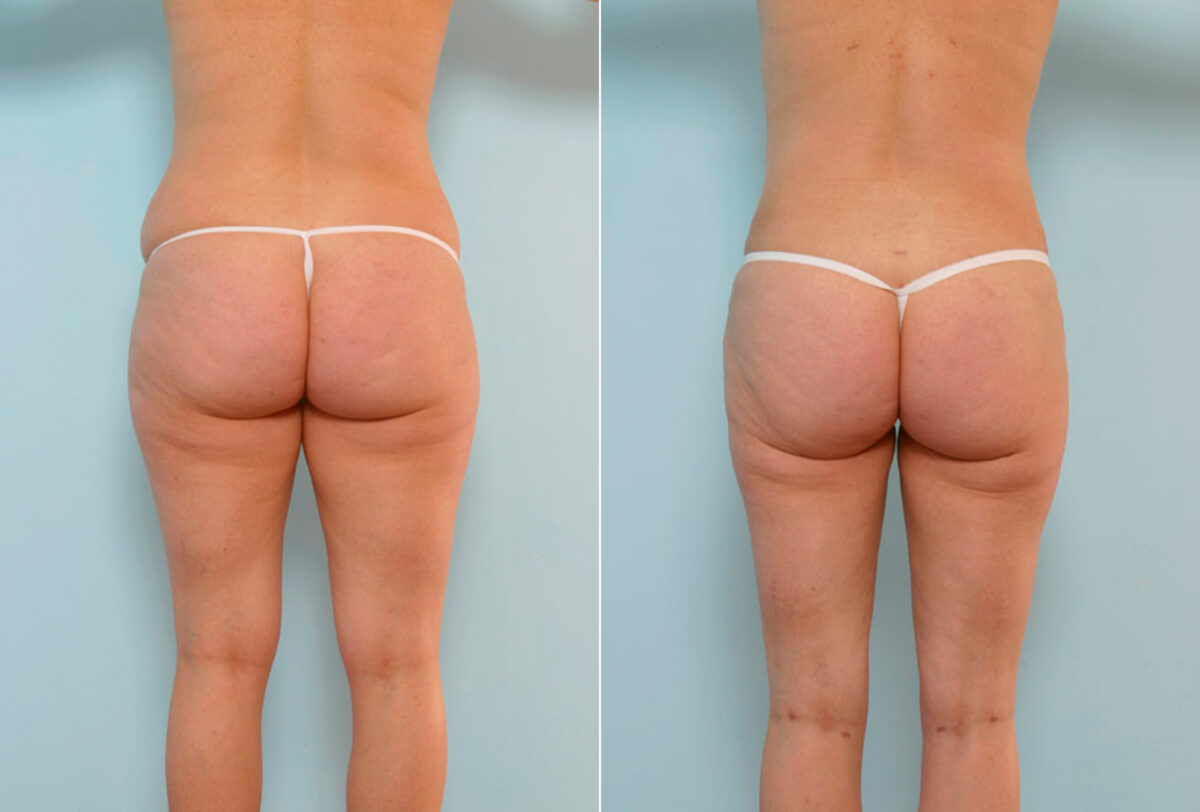 Tummy Tuck/Abdominoplasty before and after photos in Houston, TX, Patient 24487