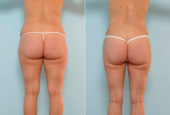 Tummy Tuck/Abdominoplasty before and after photos in Houston, TX, Patient 24487