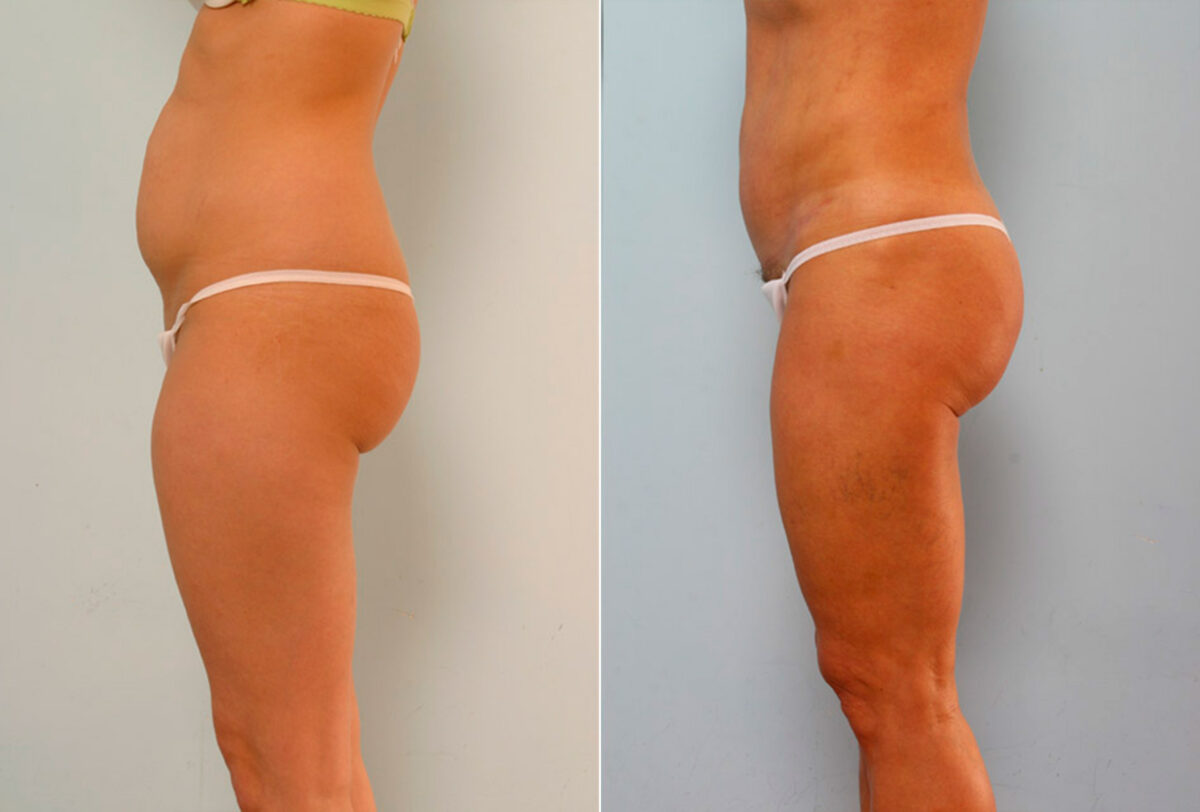 Abdominoplasty before and after photos in Houston, TX, Patient 24219