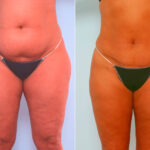 Abdominoplasty before and after photos in Houston, TX, Patient 24505