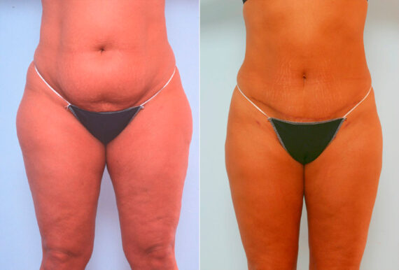 Abdominoplasty before and after photos in Houston, TX, Patient 24505