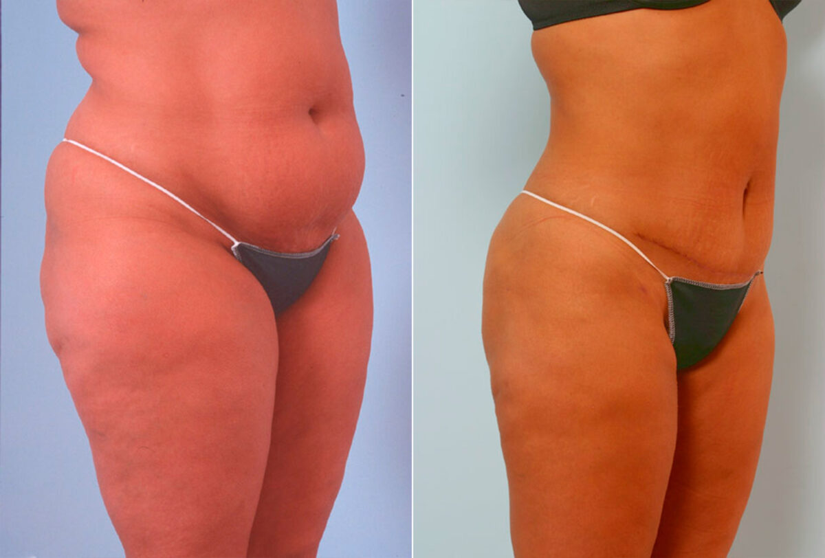 Tummy Tuck/Abdominoplasty before and after photos in Houston, TX, Patient 24505