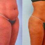 Abdominoplasty before and after photos in Houston, TX, Patient 24505