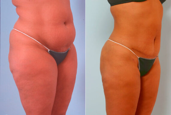 Tummy Tuck/Abdominoplasty before and after photos in Houston, TX, Patient 24505
