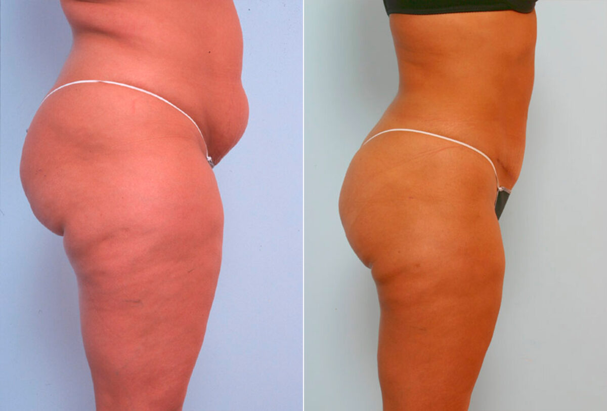 Tummy Tuck/Abdominoplasty before and after photos in Houston, TX, Patient 24505