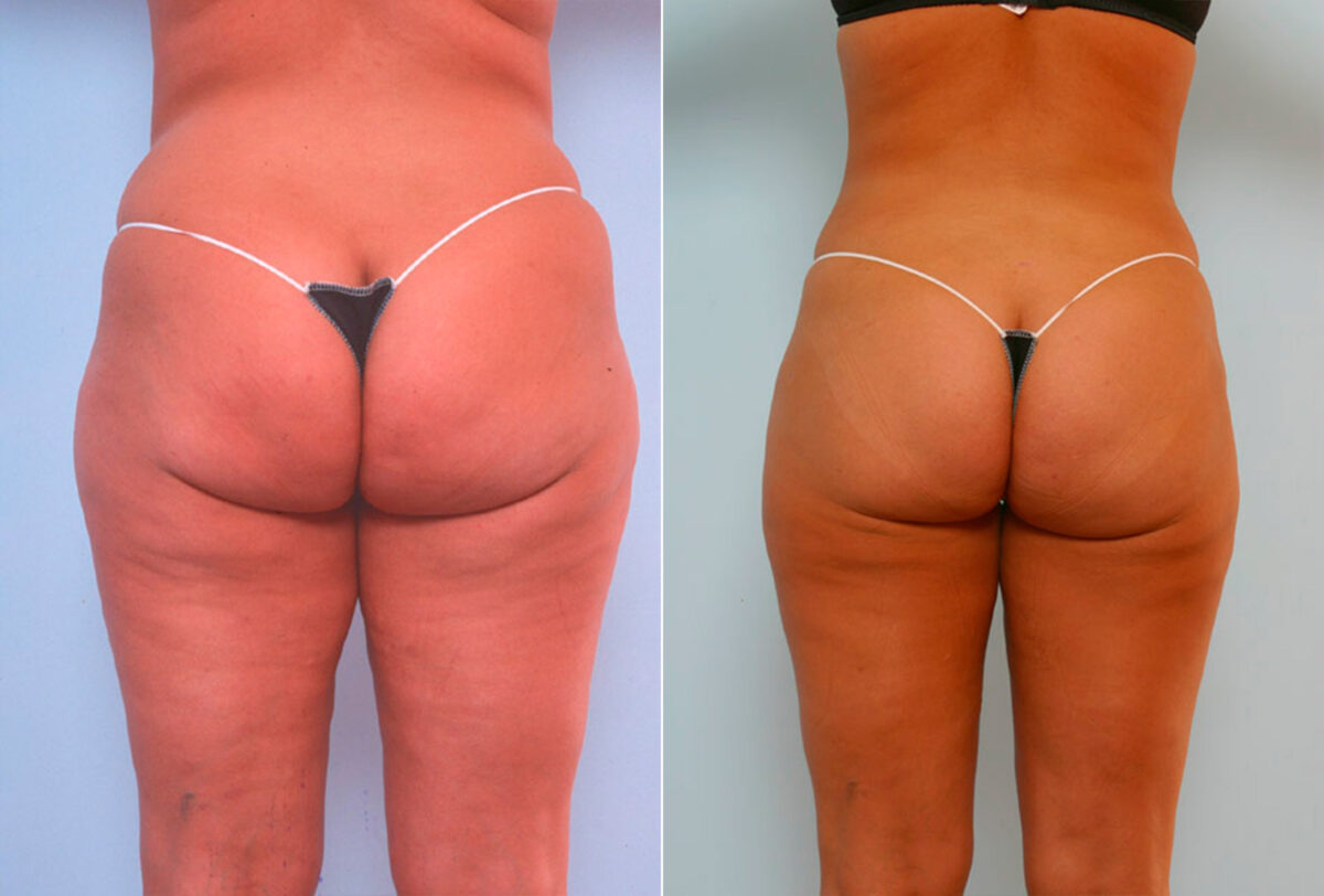 Tummy Tuck/Abdominoplasty before and after photos in Houston, TX, Patient 24505