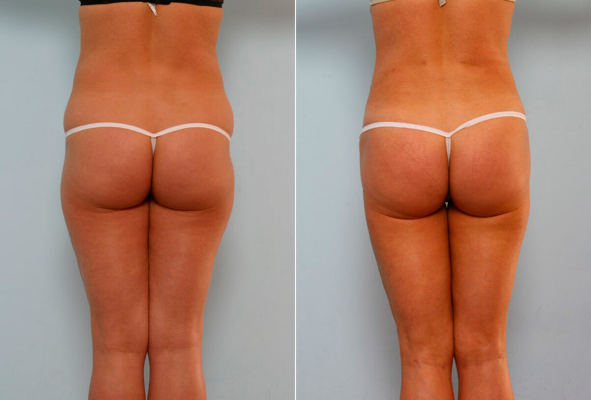 Tummy Tuck/Abdominoplasty before and after photos in Houston, TX, Patient 24219