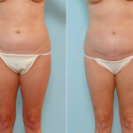 Abdominoplasty before and after photos in Houston, TX, Patient 24523