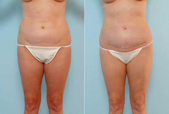 Tummy Tuck/Abdominoplasty before and after photos in Houston, TX, Patient 24523