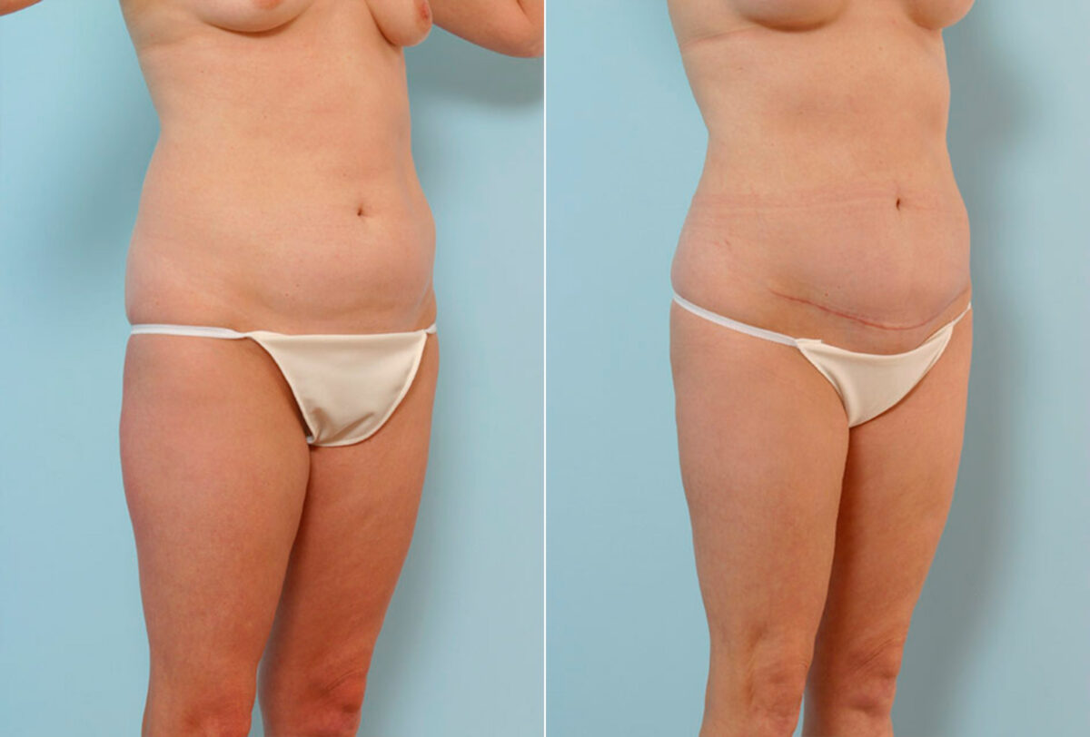 Abdominoplasty before and after photos in Houston, TX, Patient 24523