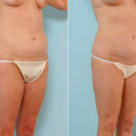 Abdominoplasty before and after photos in Houston, TX, Patient 24523