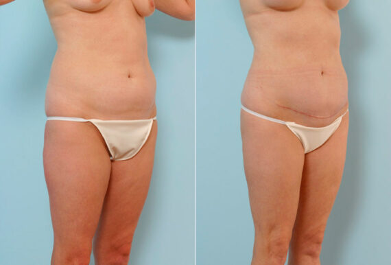 Tummy Tuck/Abdominoplasty before and after photos in Houston, TX, Patient 24523