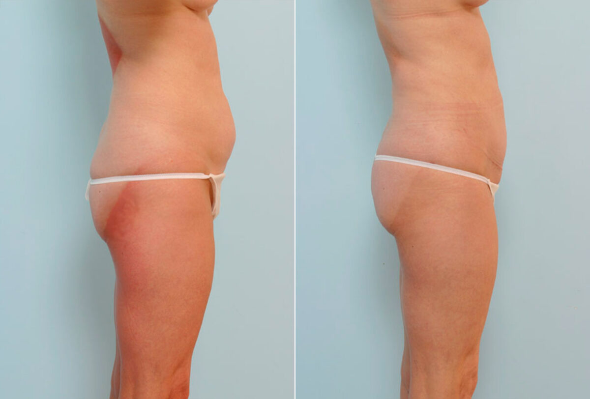 Tummy Tuck/Abdominoplasty before and after photos in Houston, TX, Patient 24523