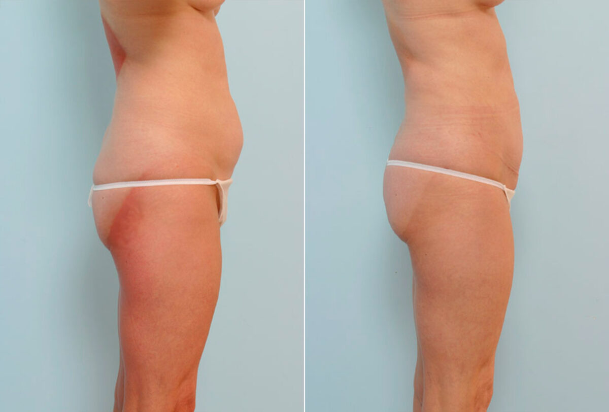 Abdominoplasty before and after photos in Houston, TX, Patient 24523