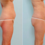 Abdominoplasty before and after photos in Houston, TX, Patient 24523