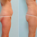 Abdominoplasty before and after photos in Houston, TX, Patient 24523