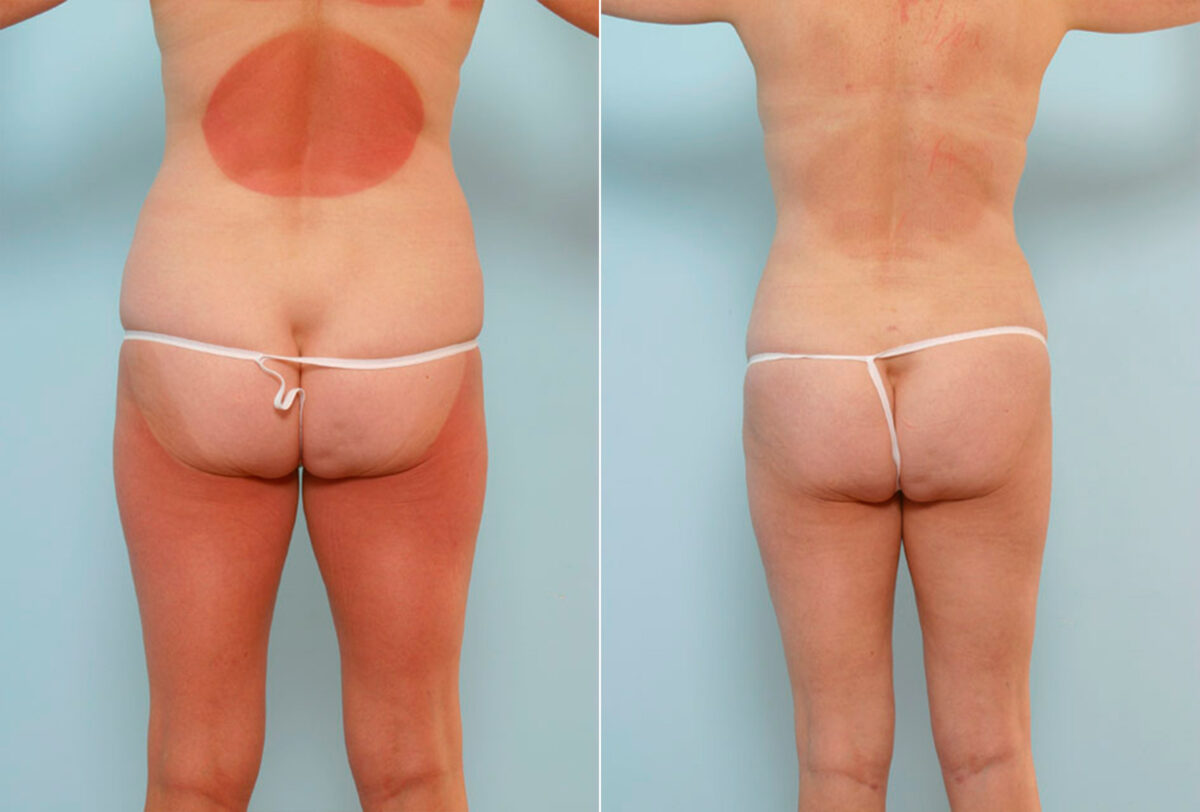 Tummy Tuck/Abdominoplasty before and after photos in Houston, TX, Patient 24523
