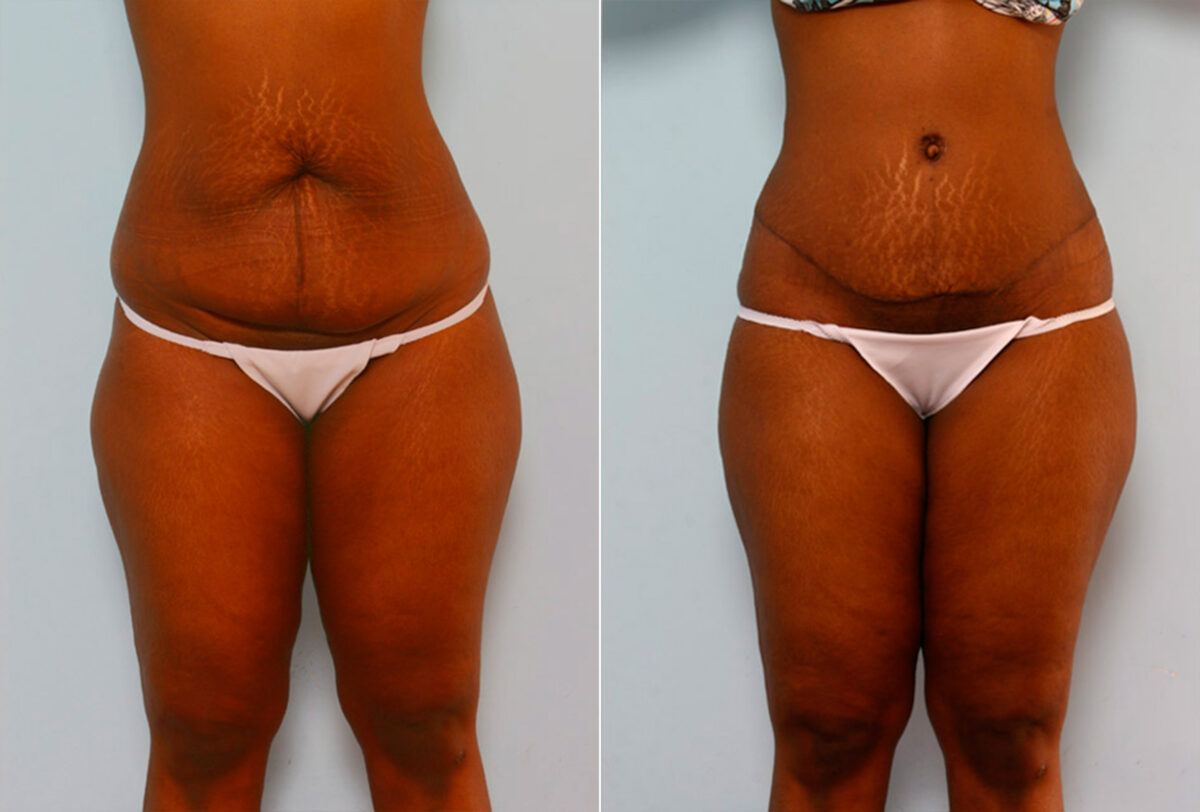 Abdominoplasty before and after photos in Houston, TX, Patient 24232