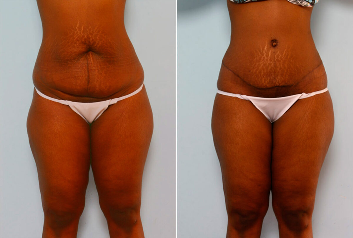 Tummy Tuck/Abdominoplasty before and after photos in Houston, TX, Patient 24232