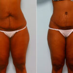 Abdominoplasty before and after photos in Houston, TX, Patient 24232