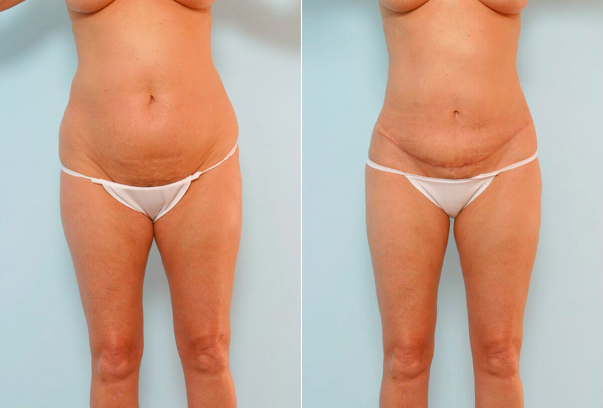 Abdominoplasty before and after photos in Houston, TX, Patient 24541
