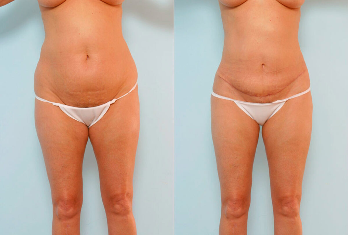 Tummy Tuck/Abdominoplasty before and after photos in Houston, TX, Patient 24541