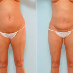 Abdominoplasty before and after photos in Houston, TX, Patient 24541