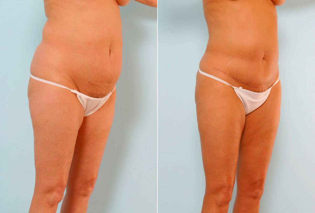 Abdominoplasty before and after photos in Houston, TX, Patient 24541