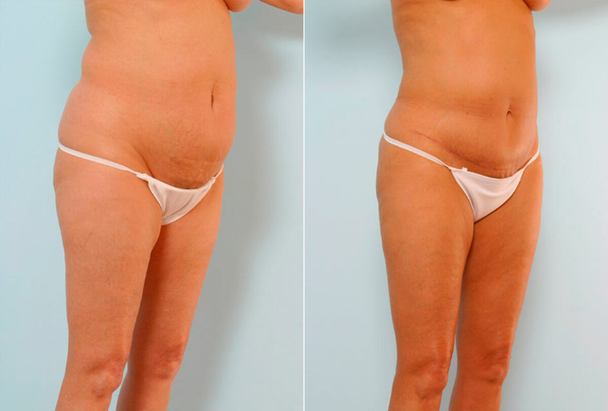 Tummy Tuck/Abdominoplasty before and after photos in Houston, TX, Patient 24541