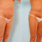 Abdominoplasty before and after photos in Houston, TX, Patient 24541