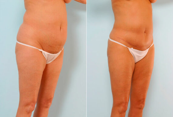 Tummy Tuck/Abdominoplasty before and after photos in Houston, TX, Patient 24541