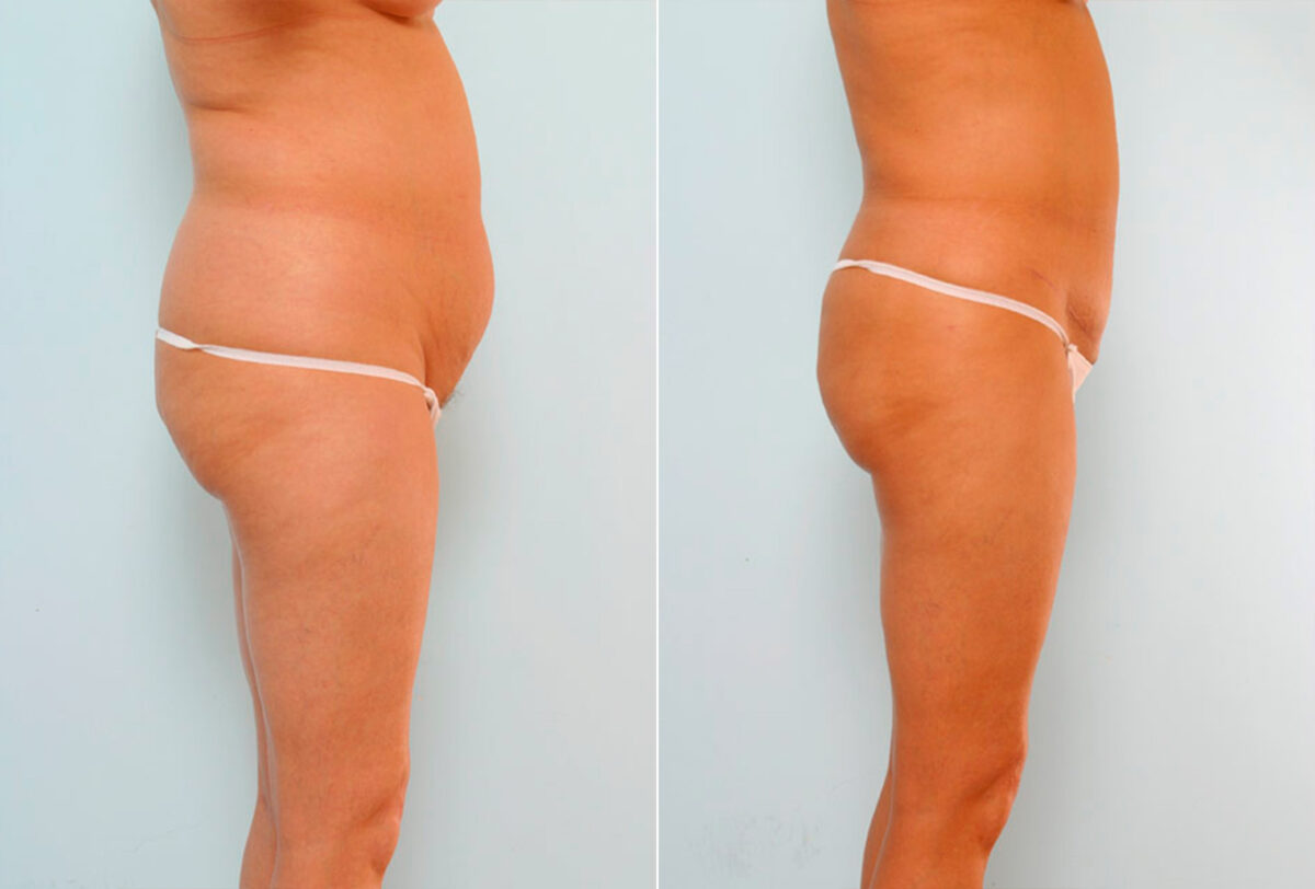 Abdominoplasty before and after photos in Houston, TX, Patient 24541