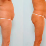 Abdominoplasty before and after photos in Houston, TX, Patient 24541