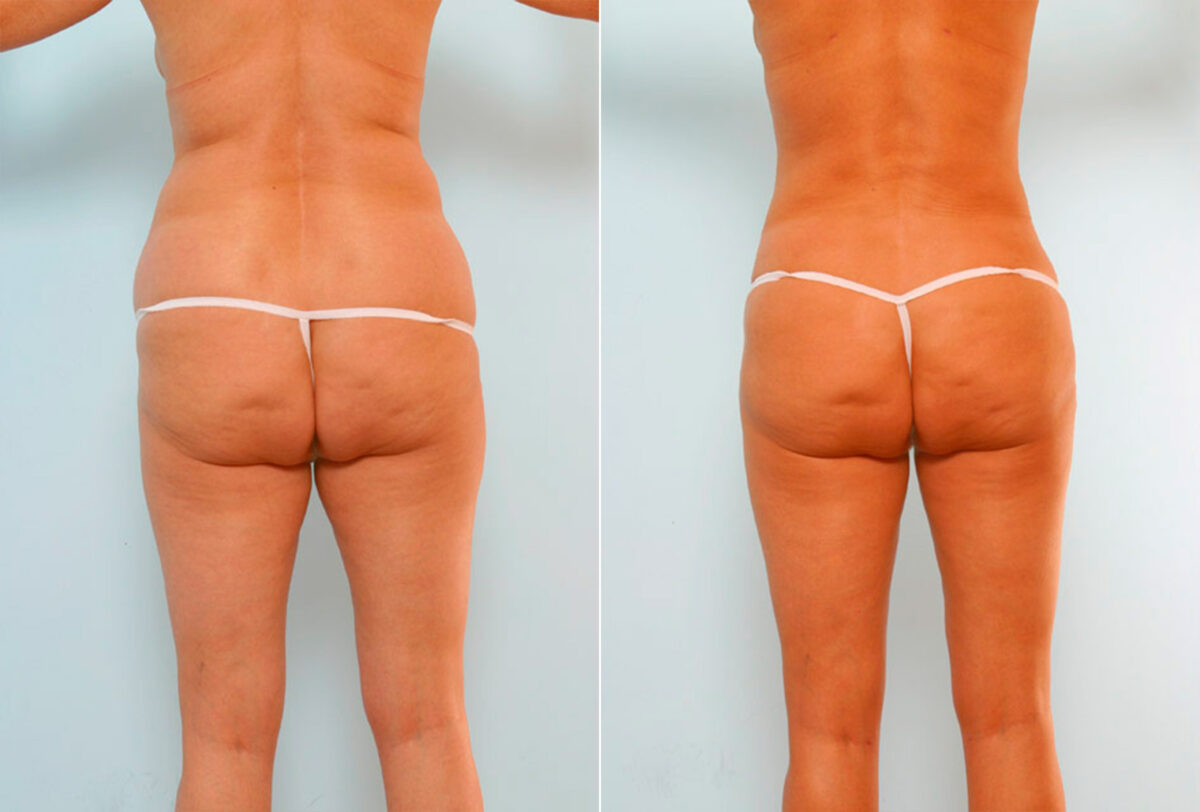 Tummy Tuck/Abdominoplasty before and after photos in Houston, TX, Patient 24541