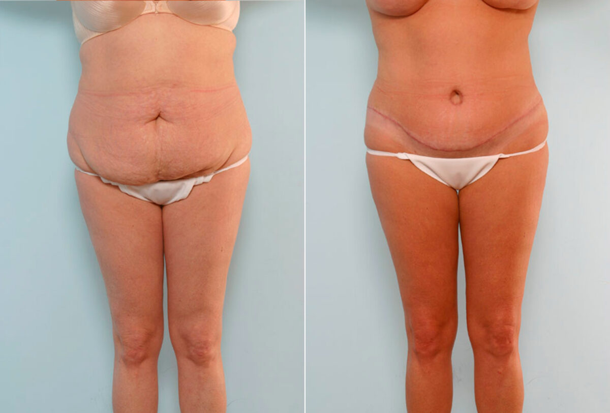 Tummy Tuck/Abdominoplasty before and after photos in Houston, TX, Patient 24550